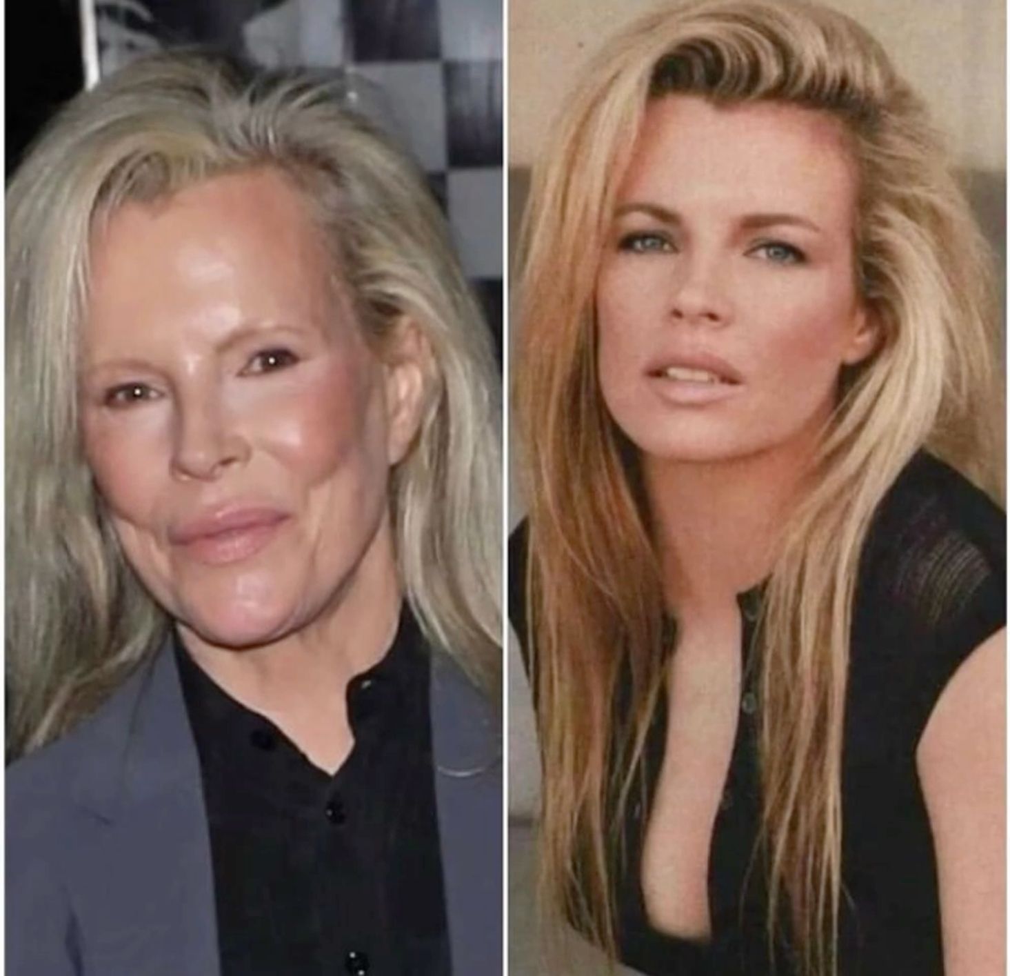 Kim Basinger Face Surgery