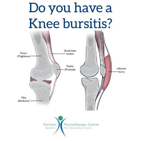 Knee Bursitis Symptoms