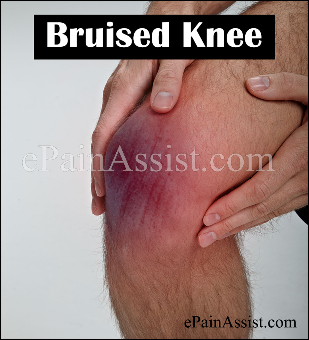 Knee Contusion Bruise