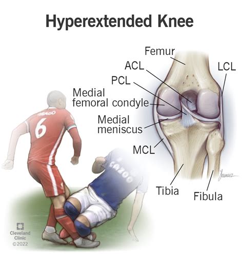 Knee Hyperextension Injury