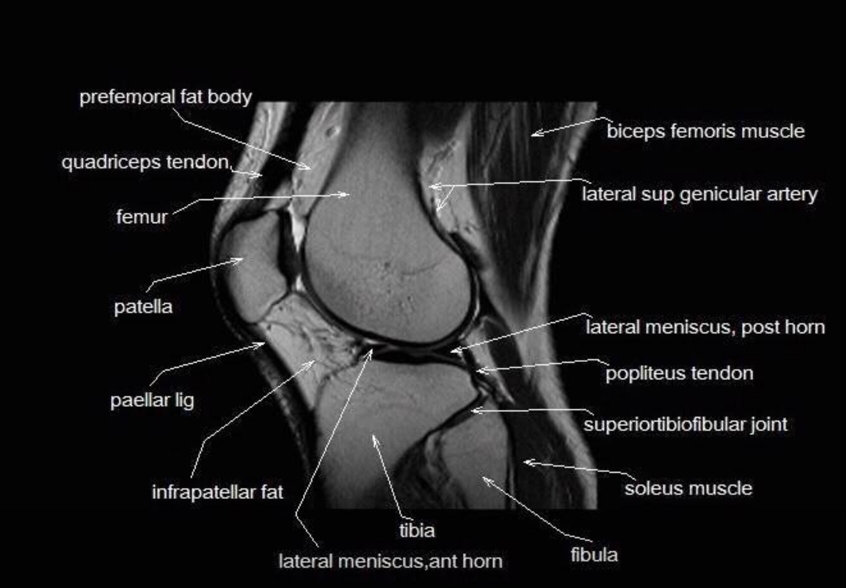 Knee Mri Images