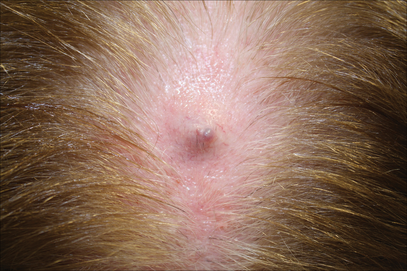 Knot On Back Of Head