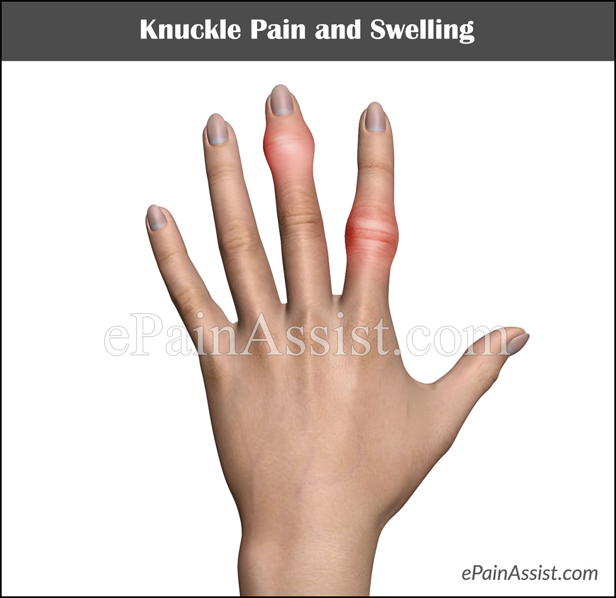 Knuckles Hurt And Ache