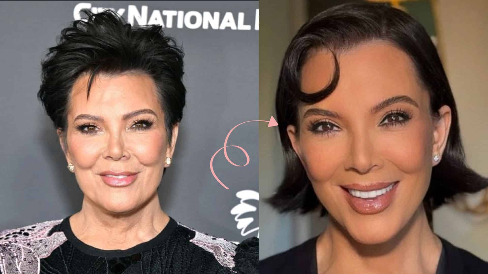 Kris Jenner Surgery Face