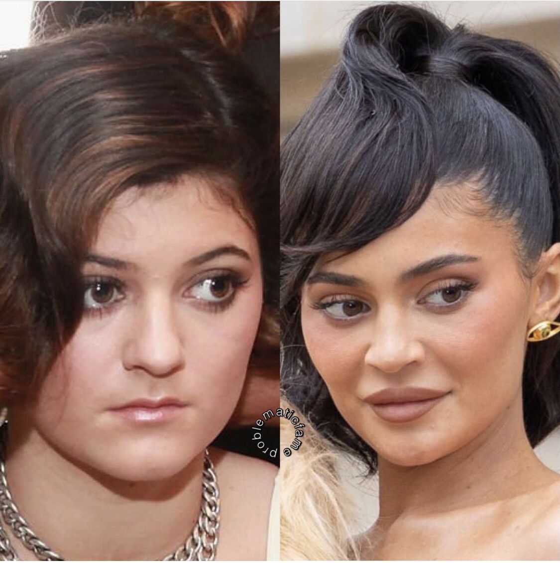 Kylie Jenner Before And After Face Surgery
