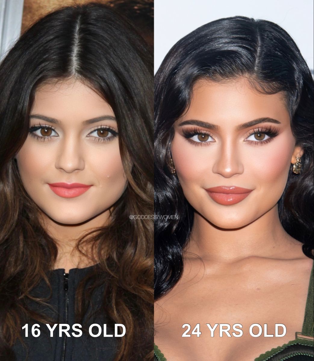 Kylie Jenner Plastic Surgery Face