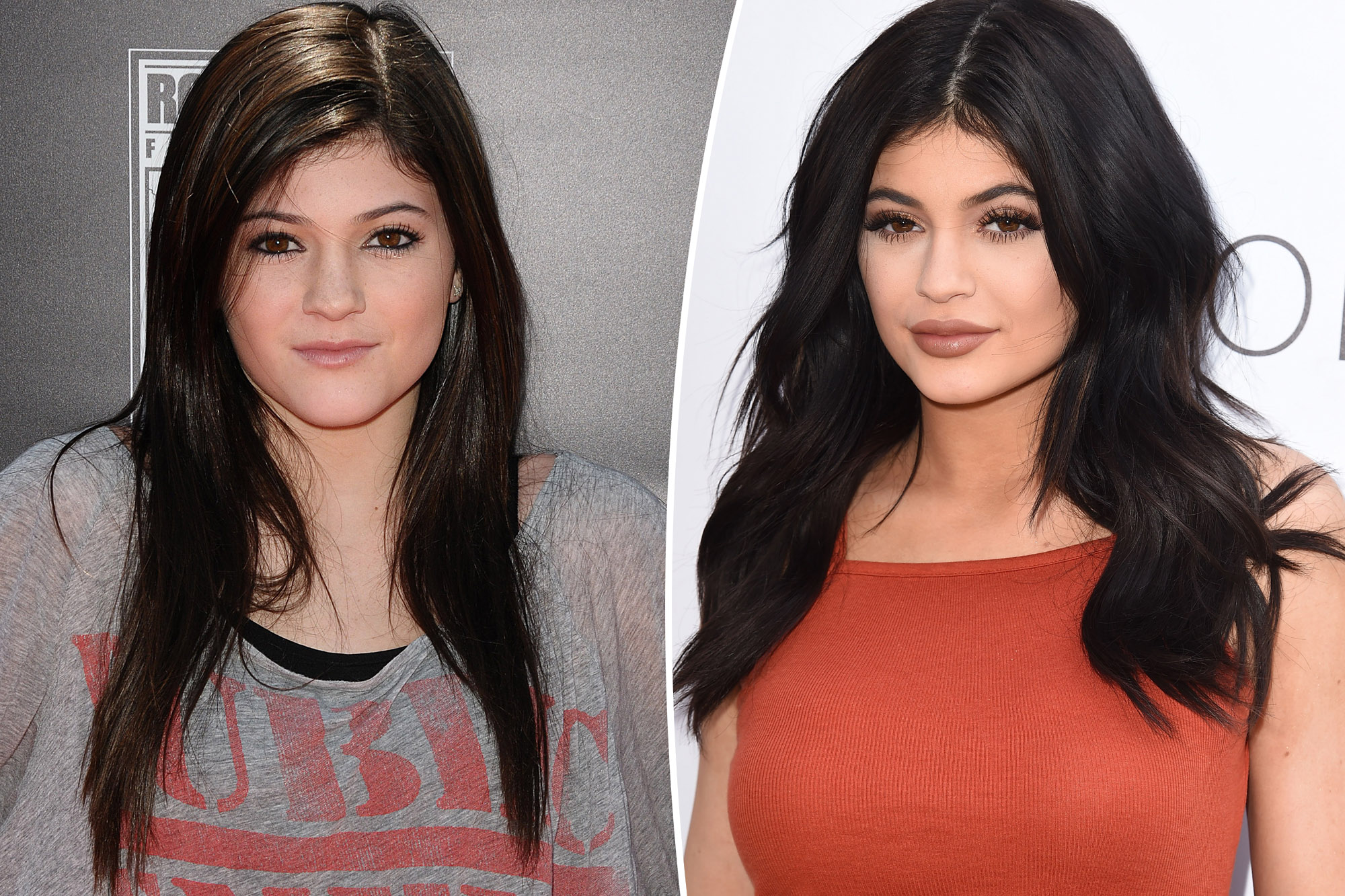 Kylie Jenner Real Face Before Surgery