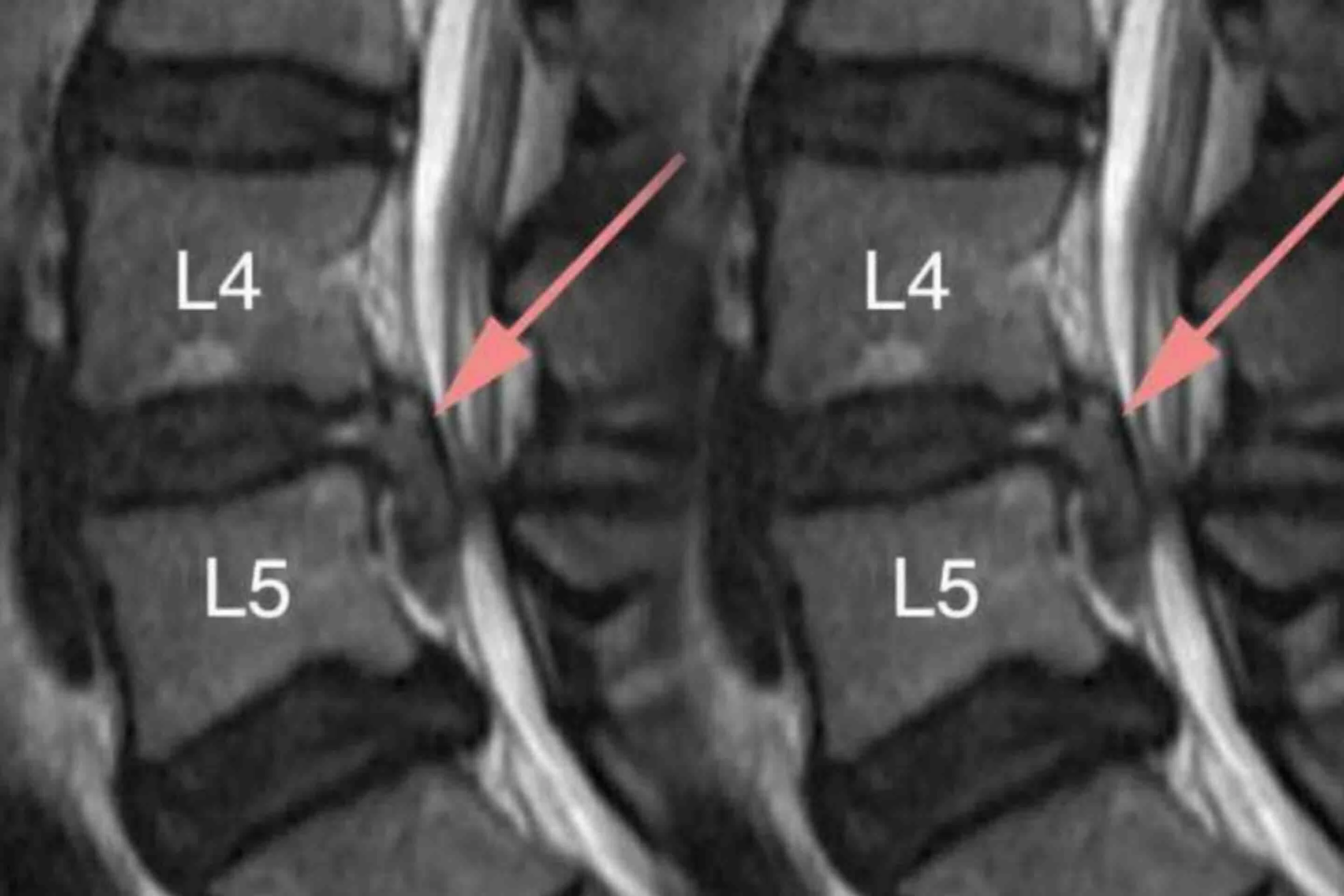 L4 And L5 Bulging Disk