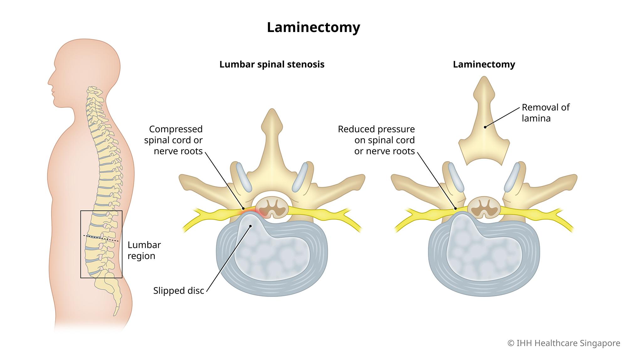 L4l5 Laminectomy Recovery Time