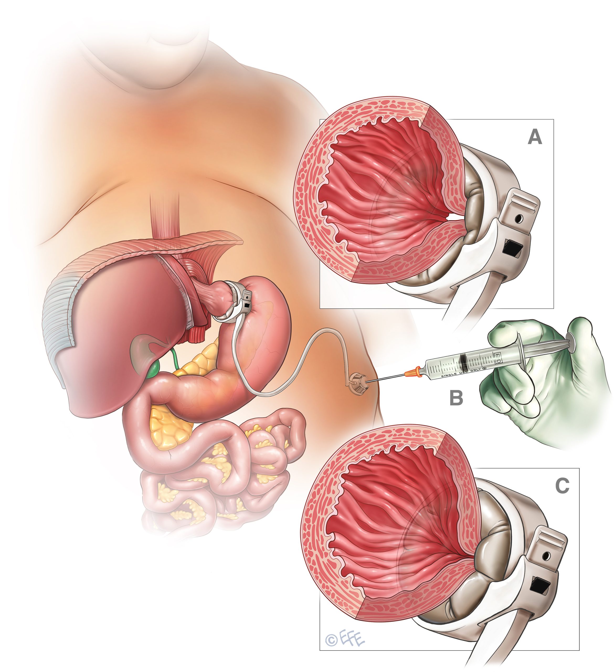 Lap Band Surgery Procedure