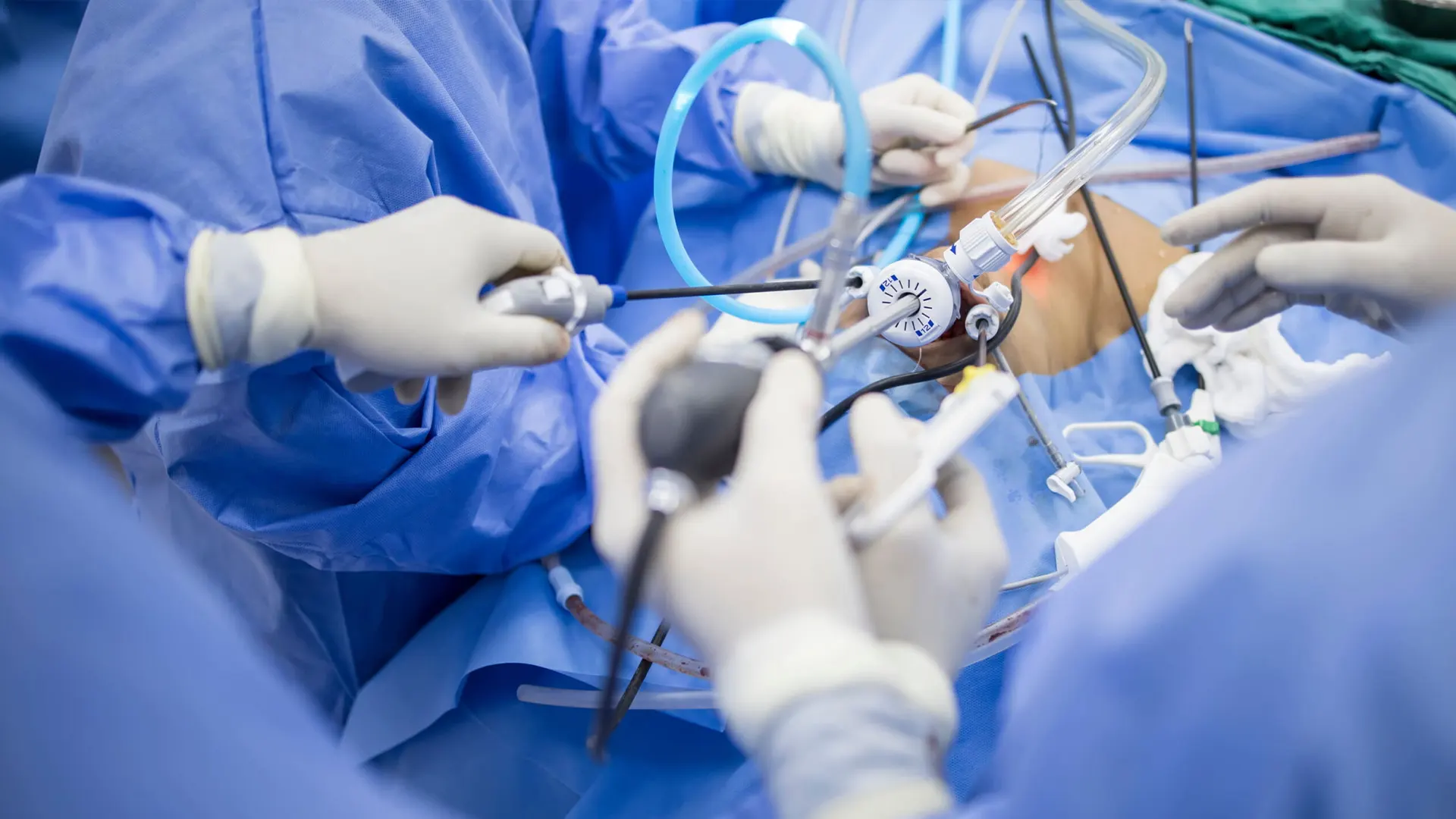 Laparoscopic Hysterectomy Men