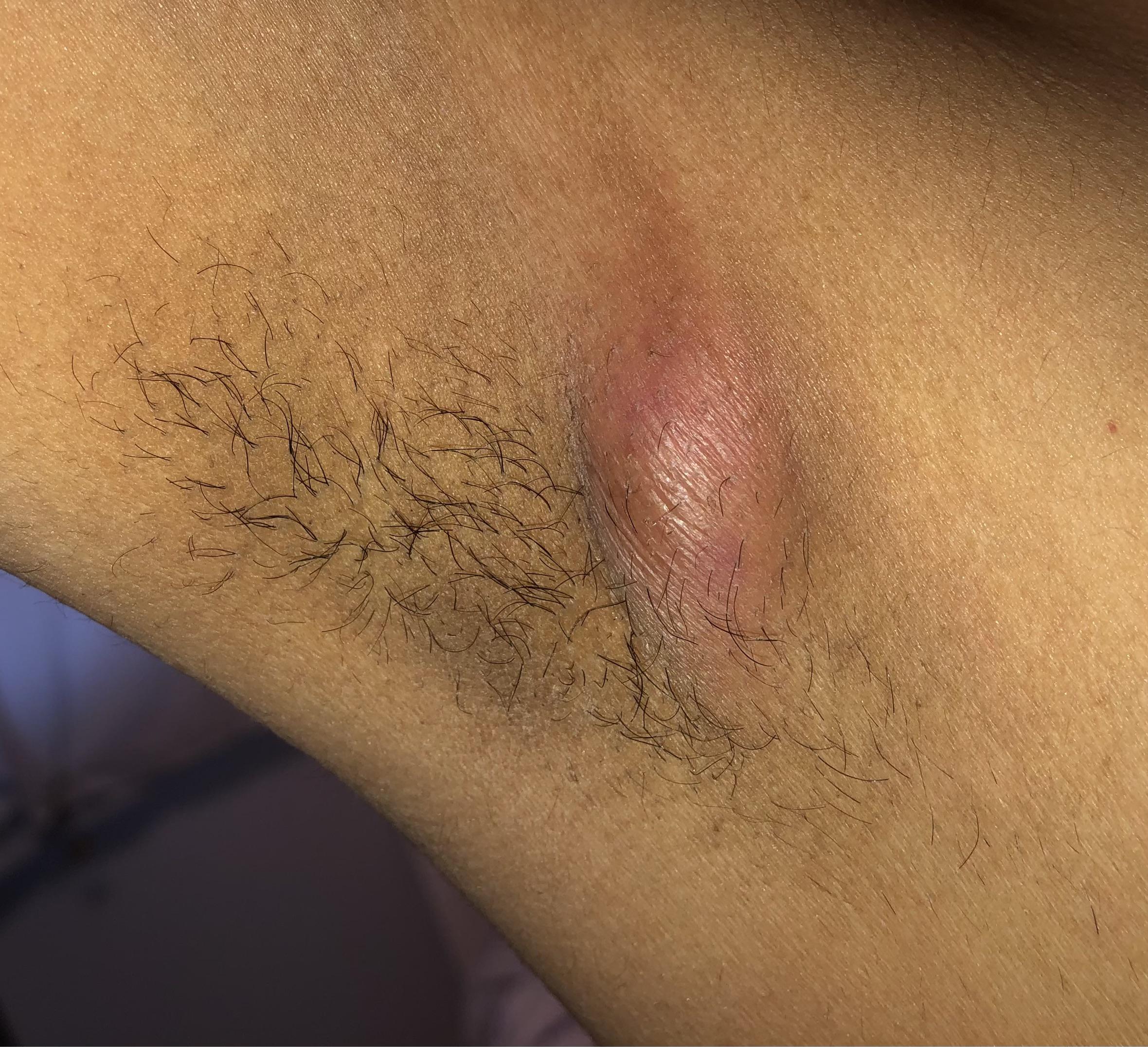 Large Bump On Armpit