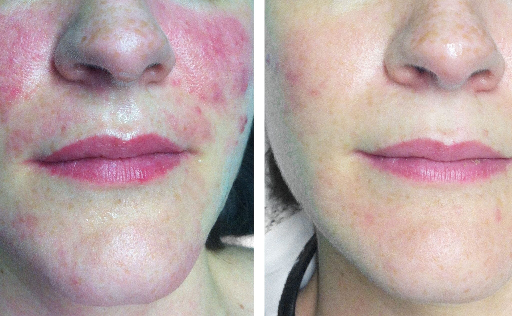 Laser En Rosacea