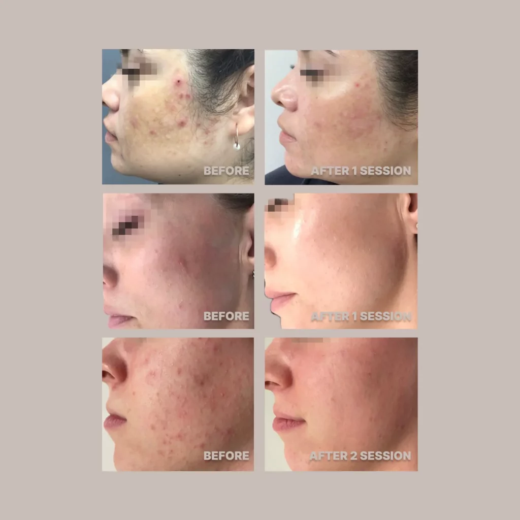 Laser Procedure For Acne