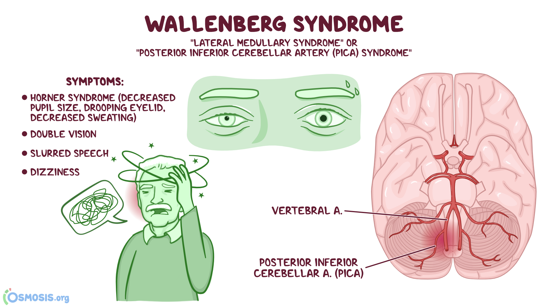 Lateral Medullary Stroke