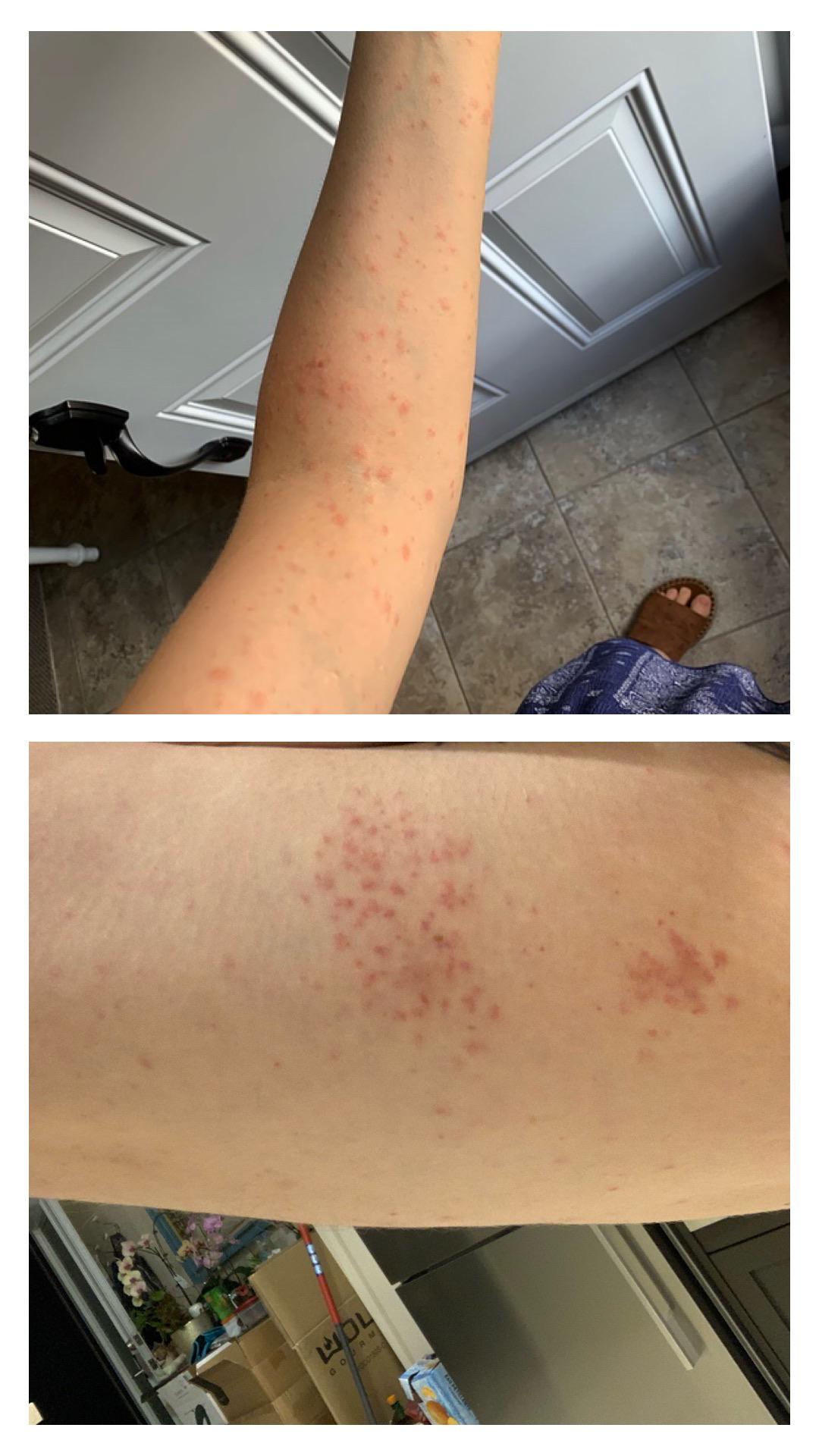 Laundry Detergent Rash