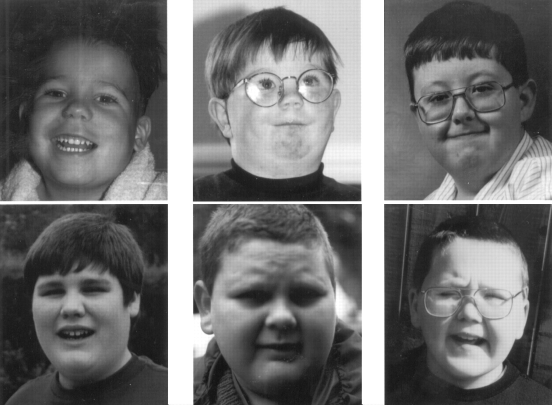 Laurence Moon Biedl Bardet Syndrome