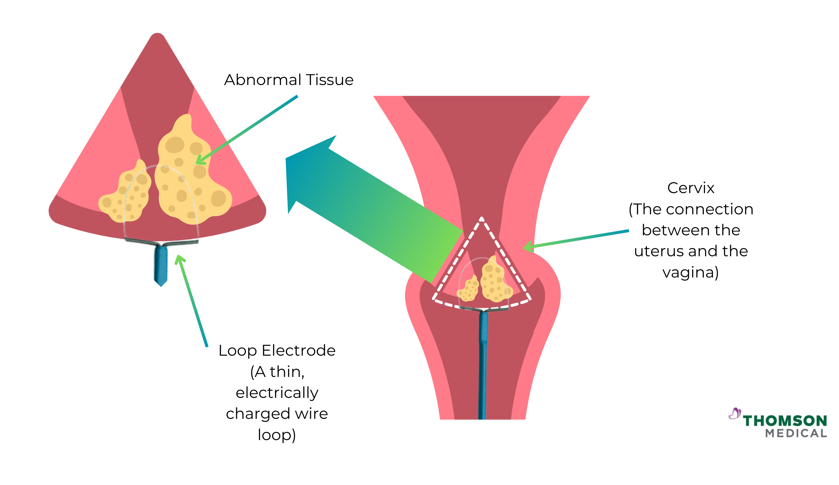 Leep Procedure For Hpv Virus
