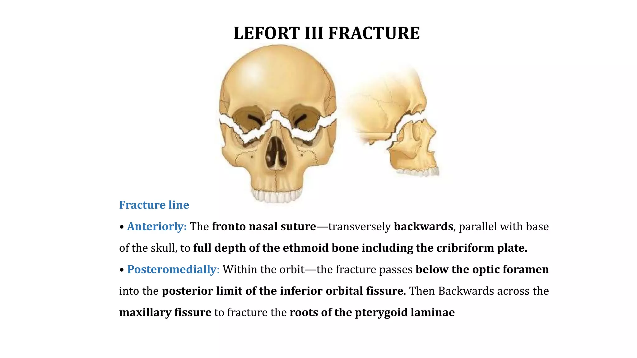 Lefort Iii Fracture