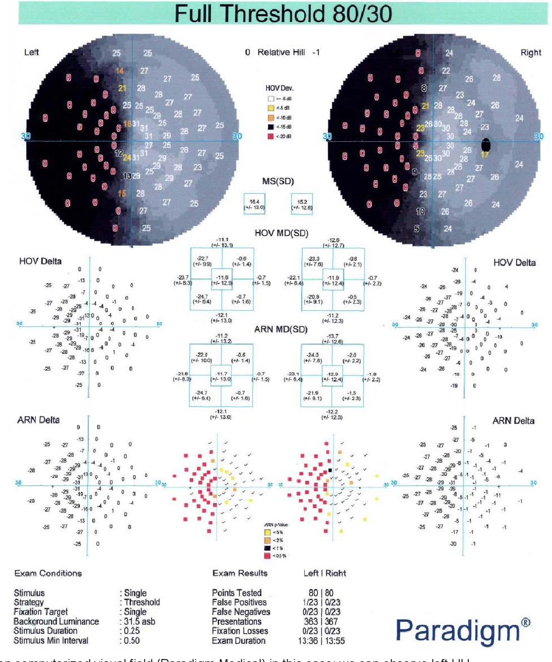 Left Homonymous Hemianopia