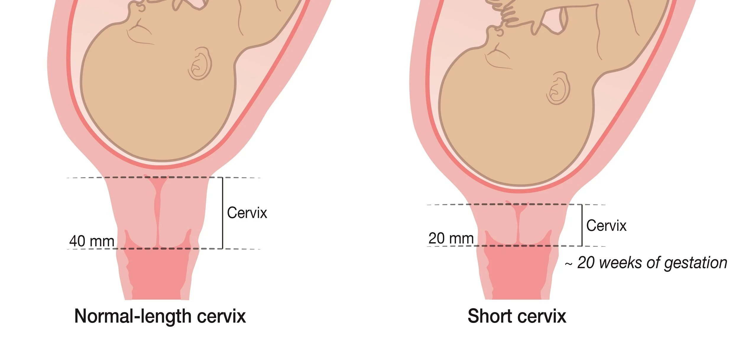 Length Of Average Cervix
