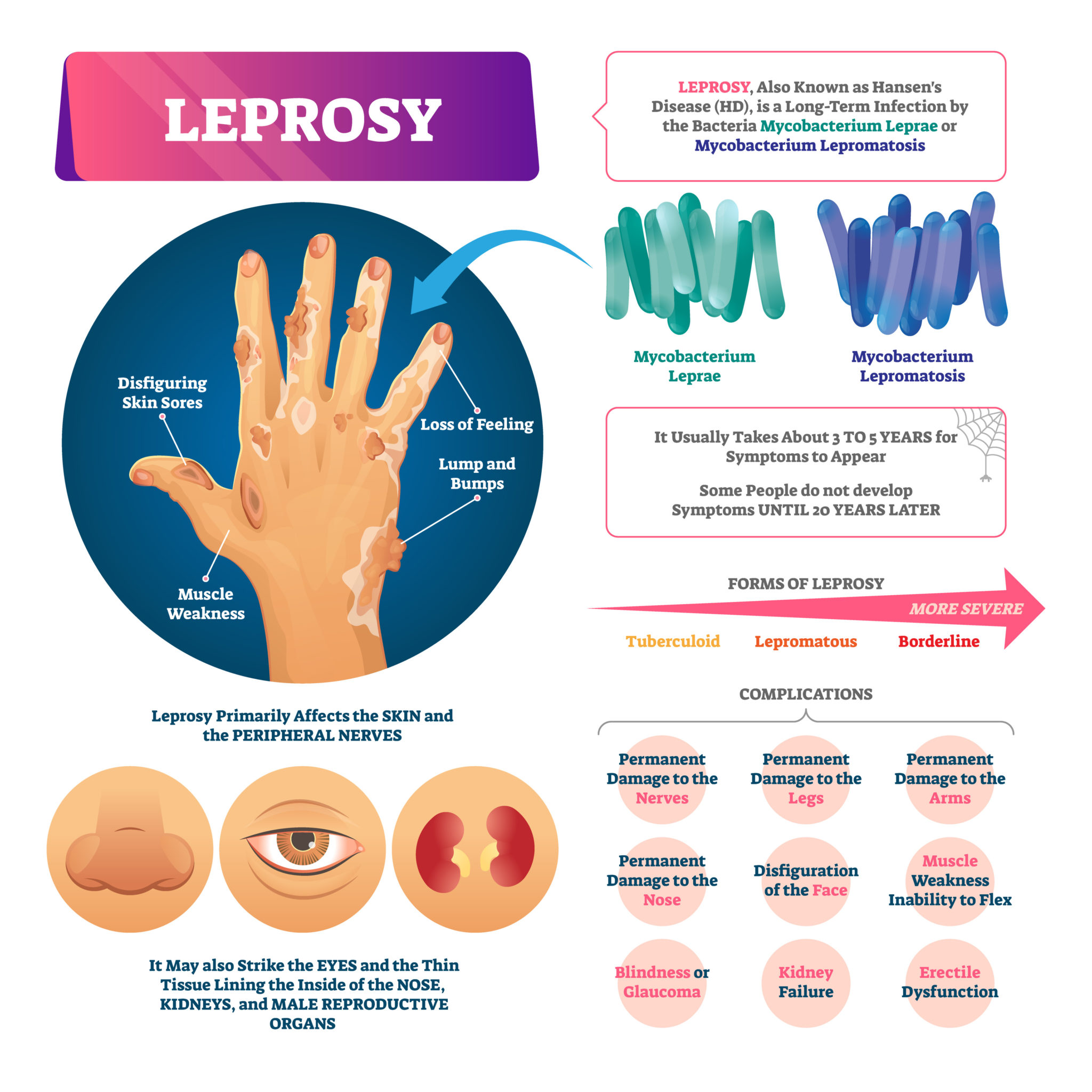 Leprosy How Spread