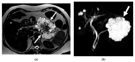 Lesion On Pancreas