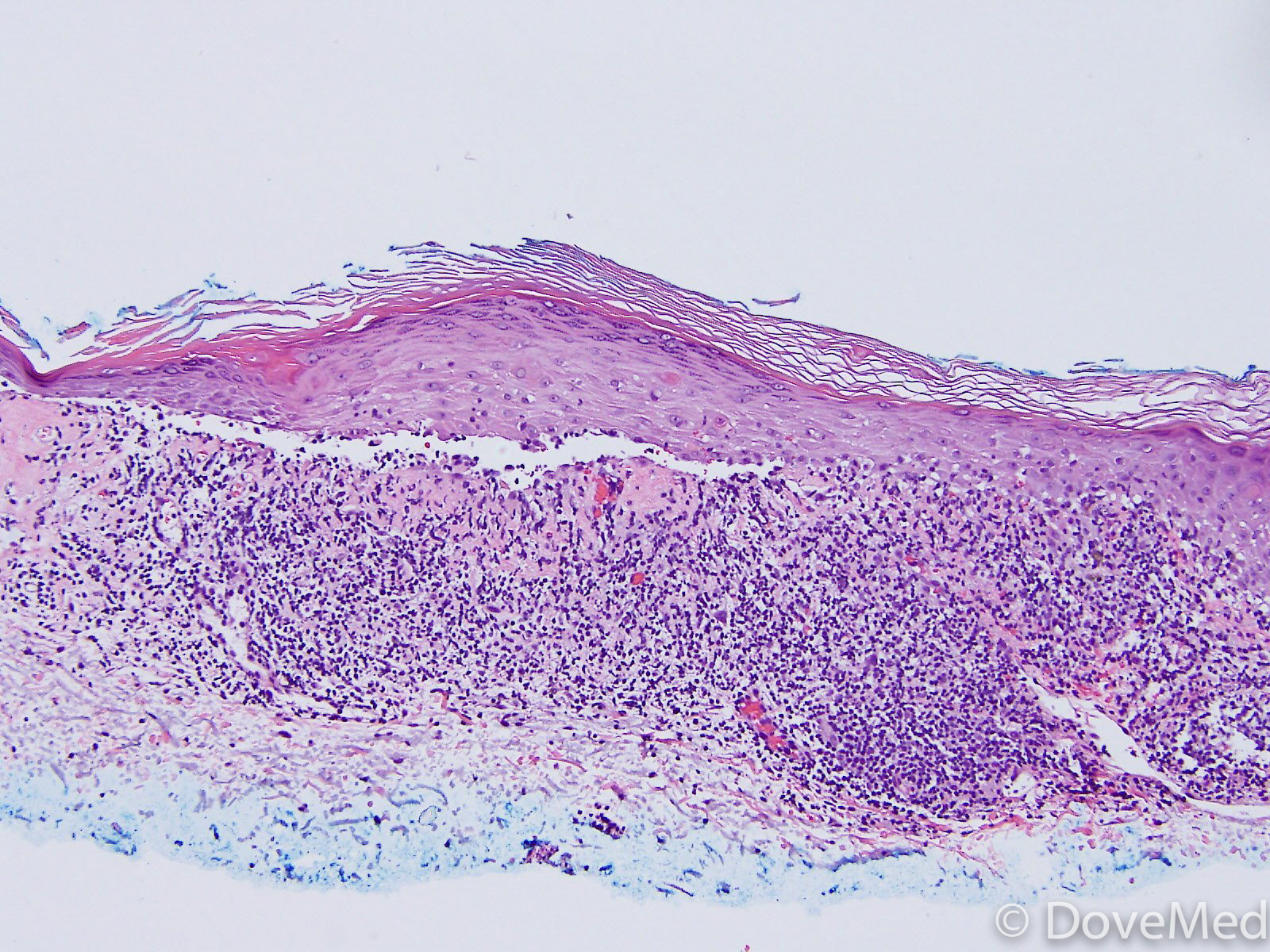 Lichen Planus Vaginal