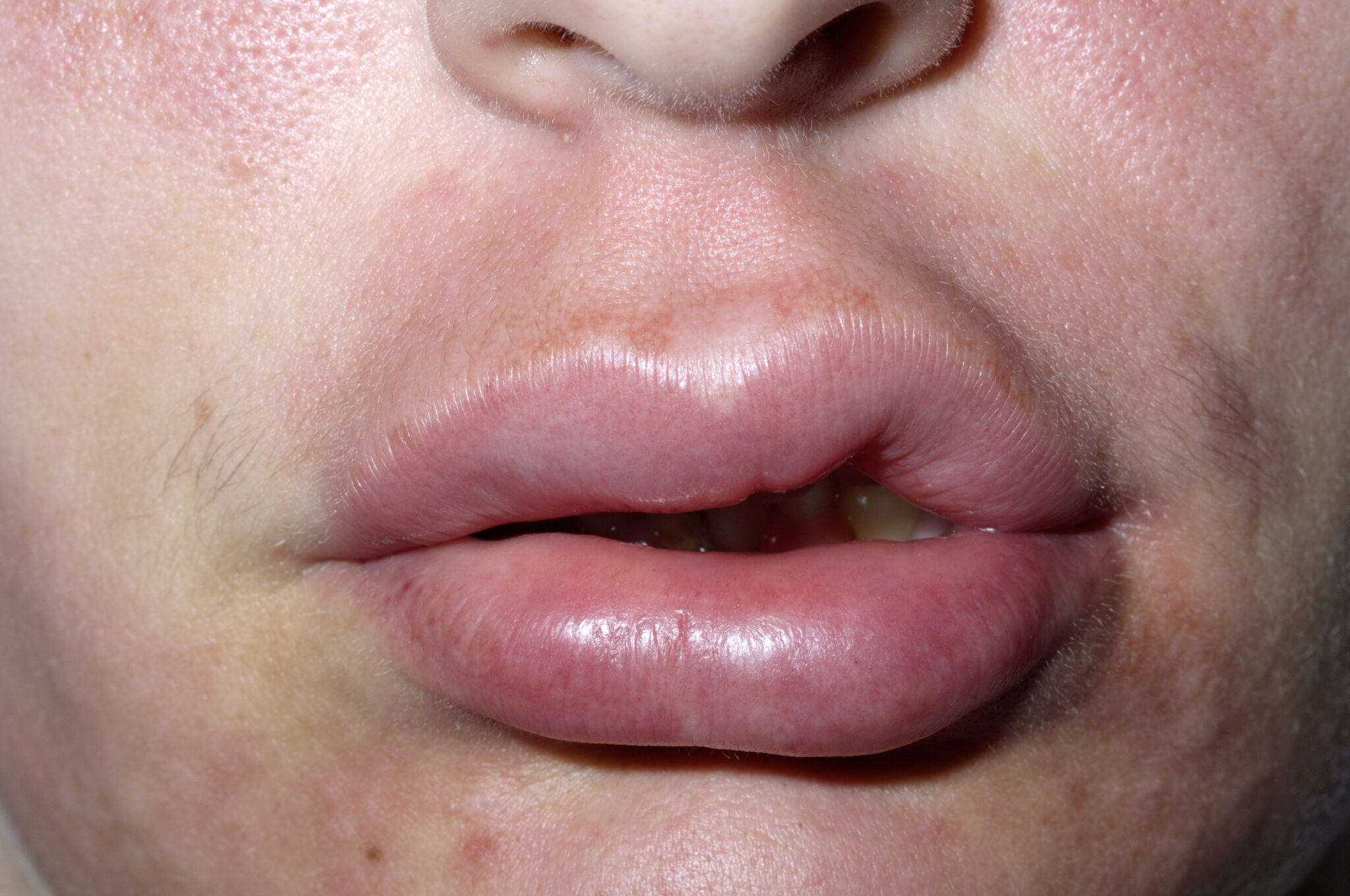 Lip Bump Swelling