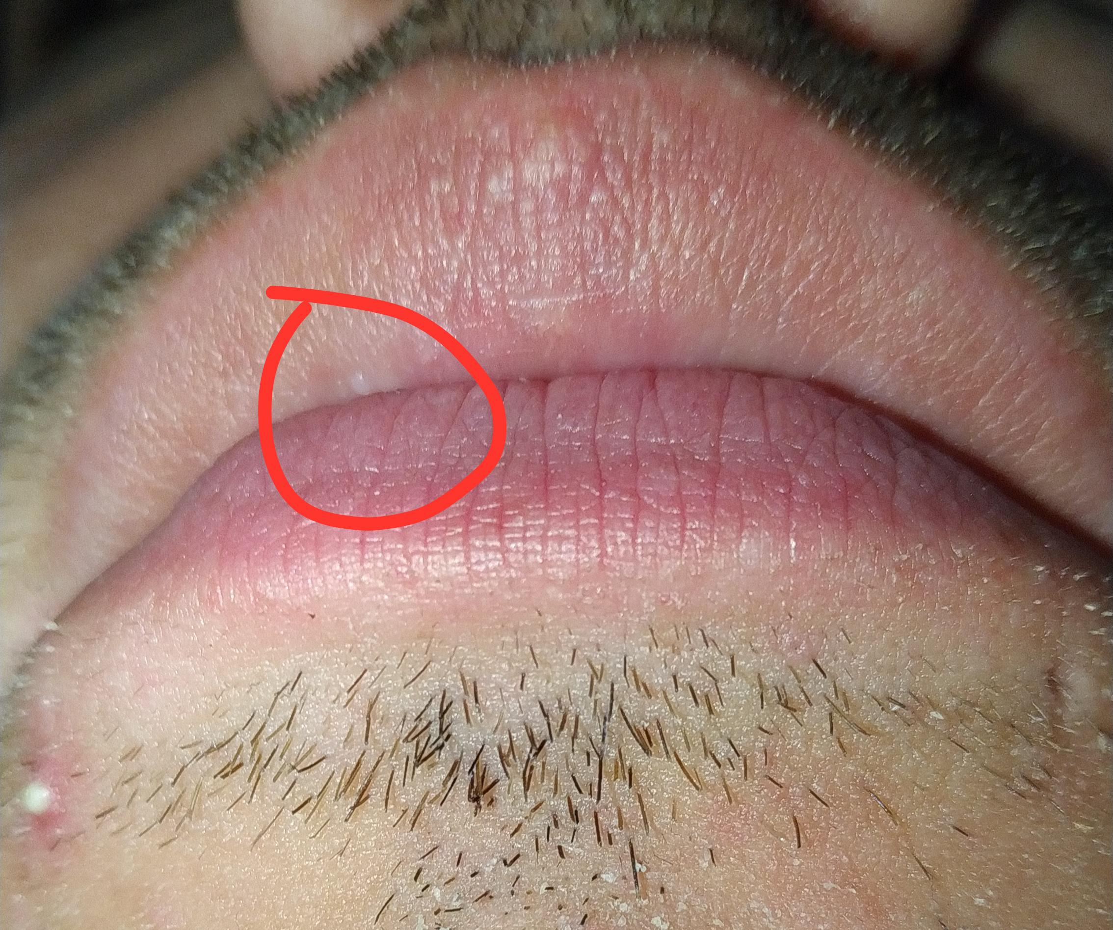 Lip Bumps White