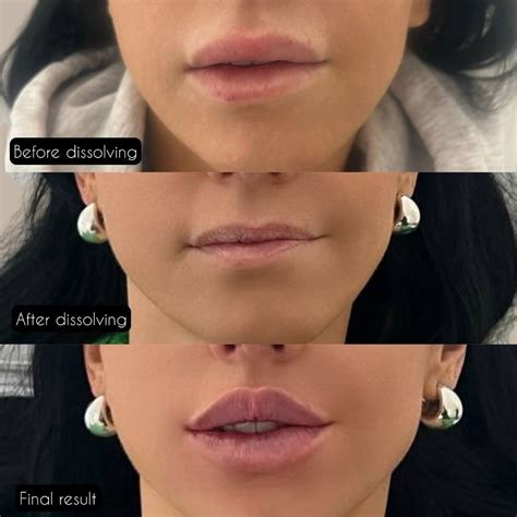 Lip Filler Dissolved