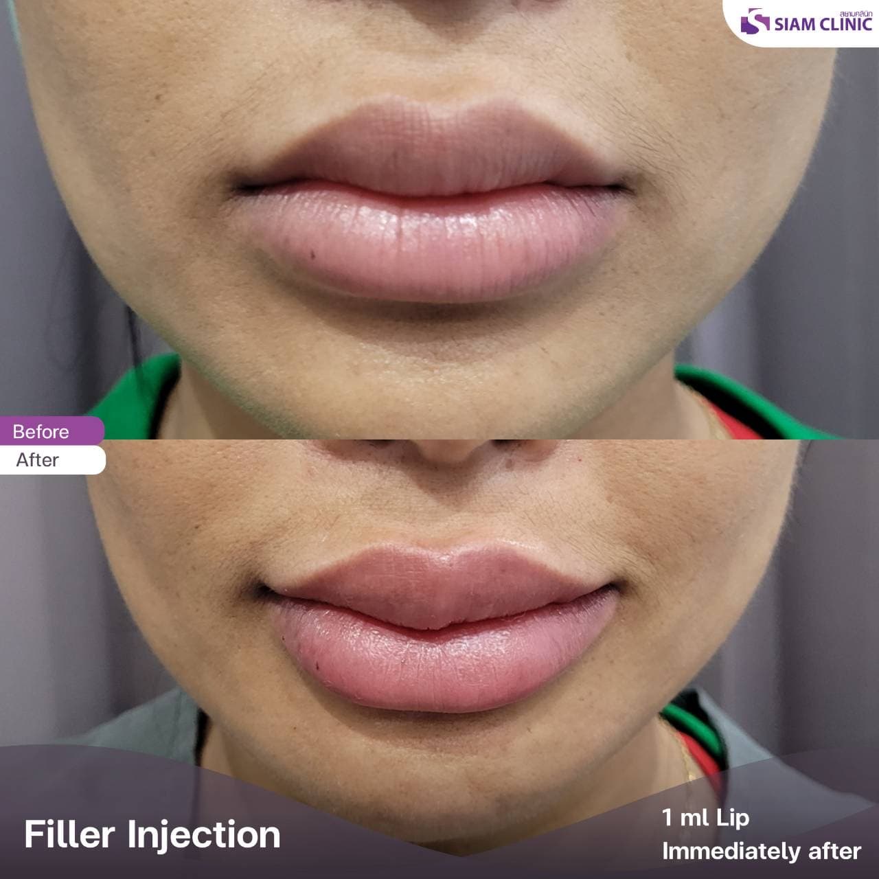 Lip Fillers Before And After