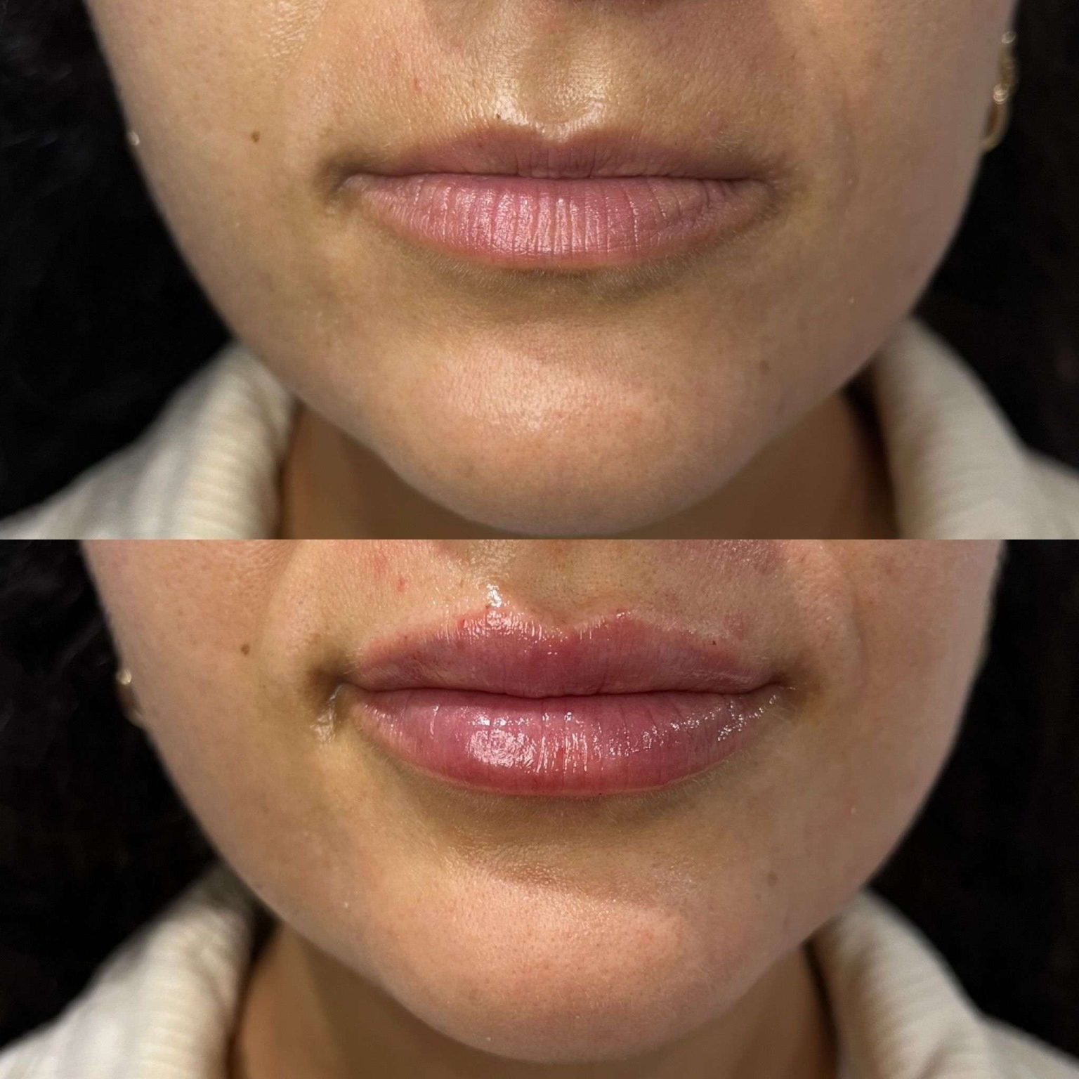 Lip Injection After Care