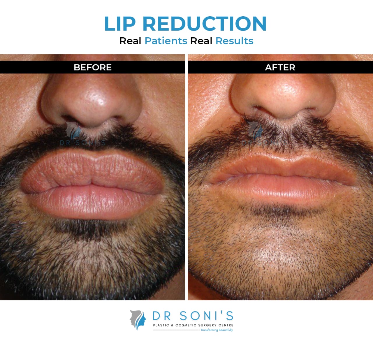 Lip Reduction Surgery