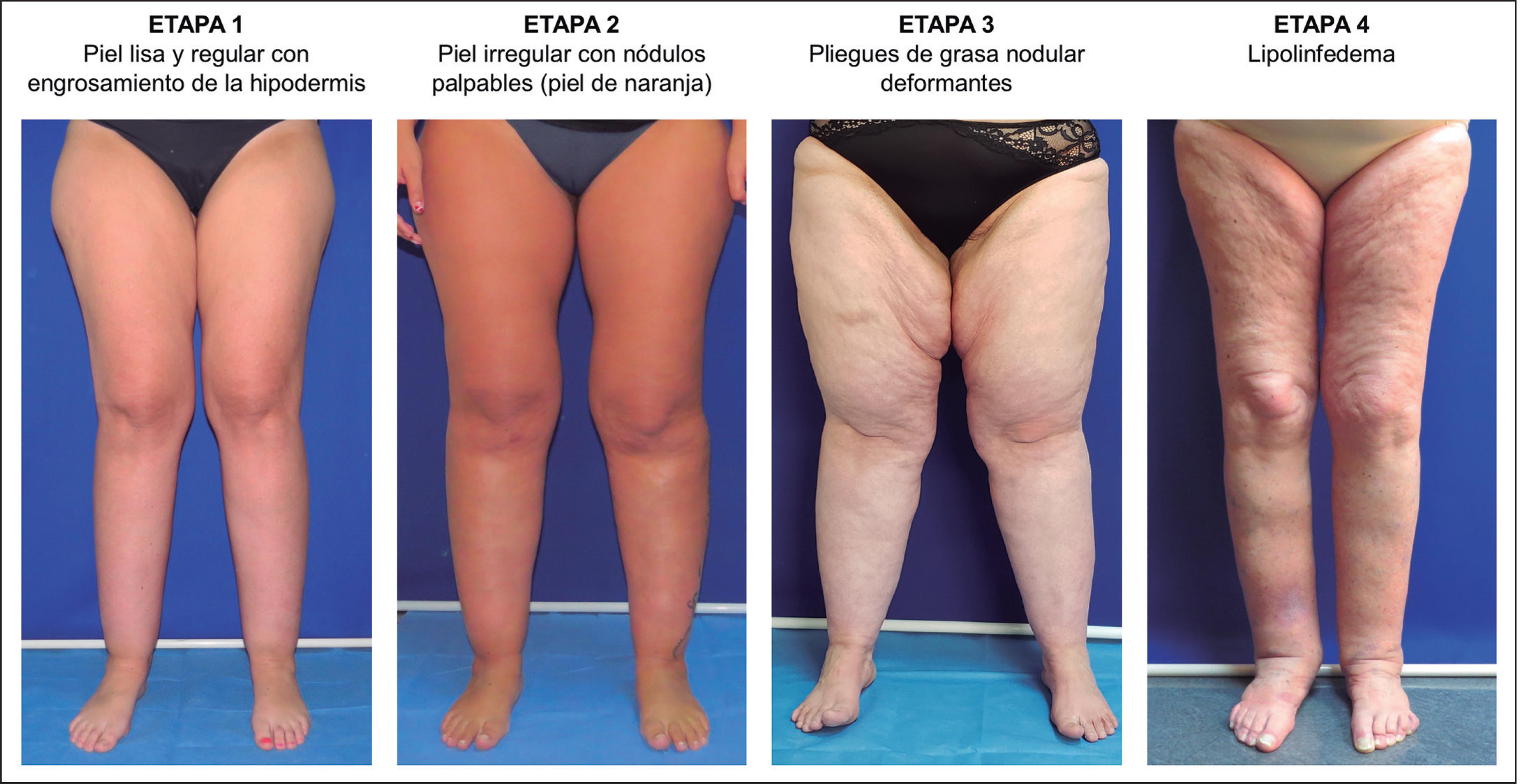 Lipedema Que Es