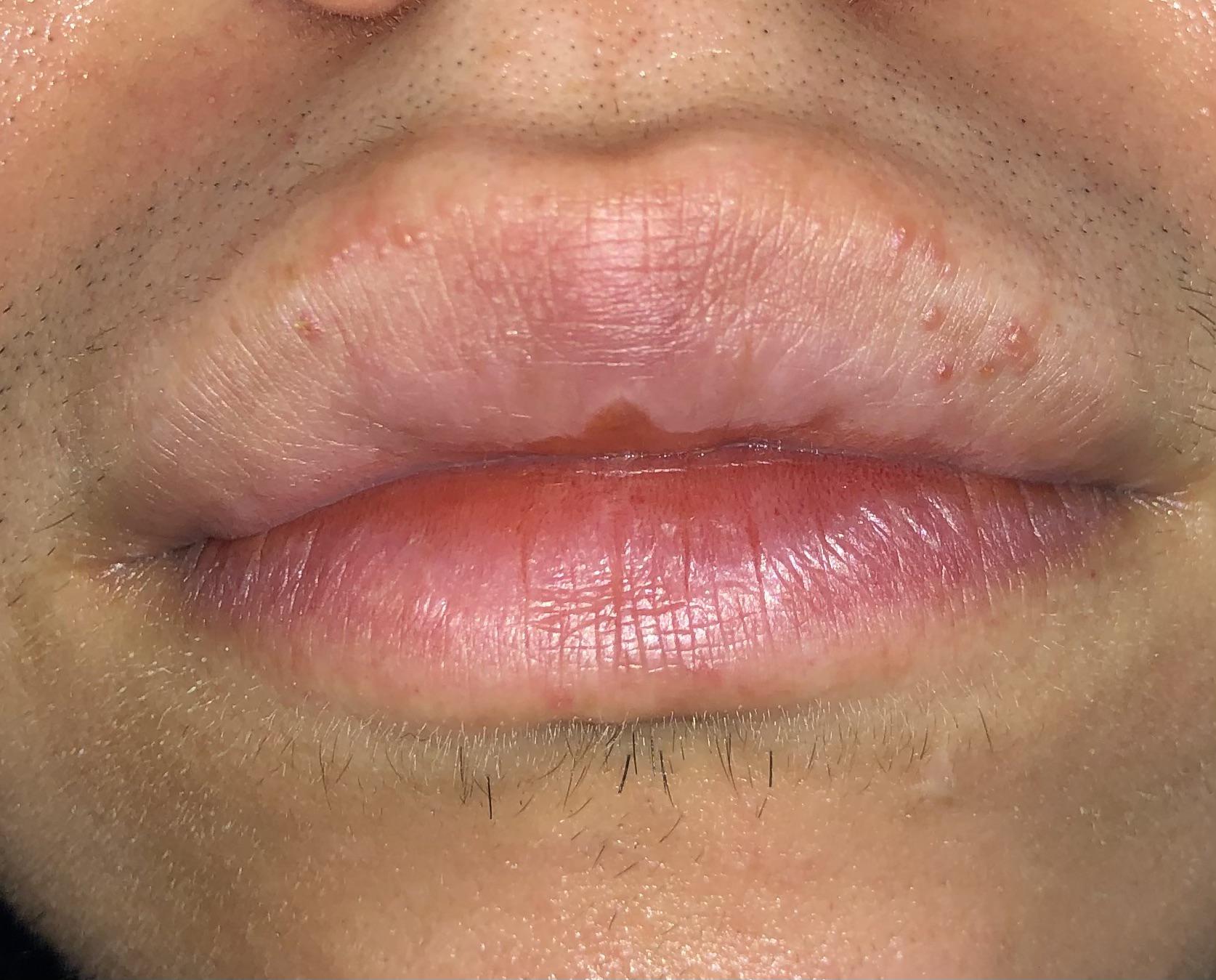 Little Bumps On Lips