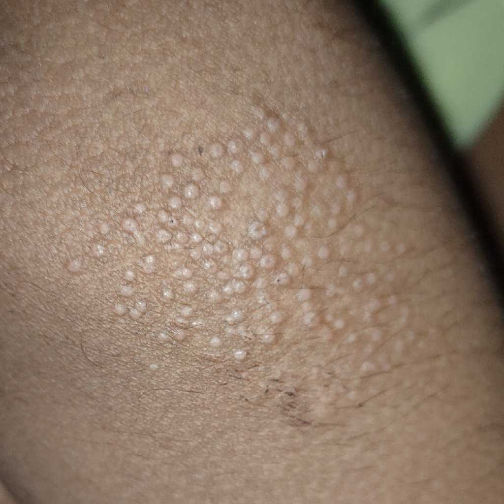 Little White Bumps On Skin