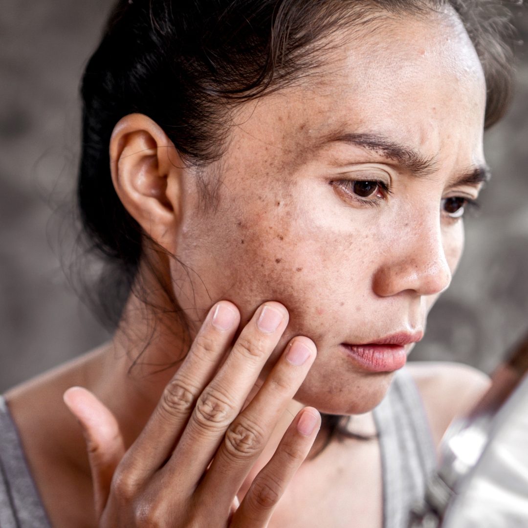 Liver Spots Treatment