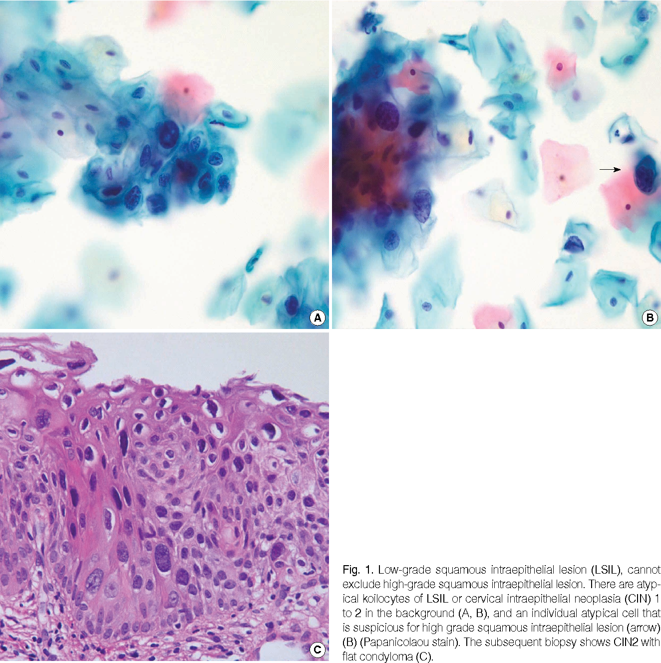Low Grade Squamous Intraepithelial Lesion