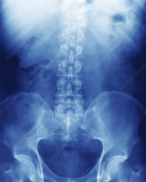Lower Back X Ray