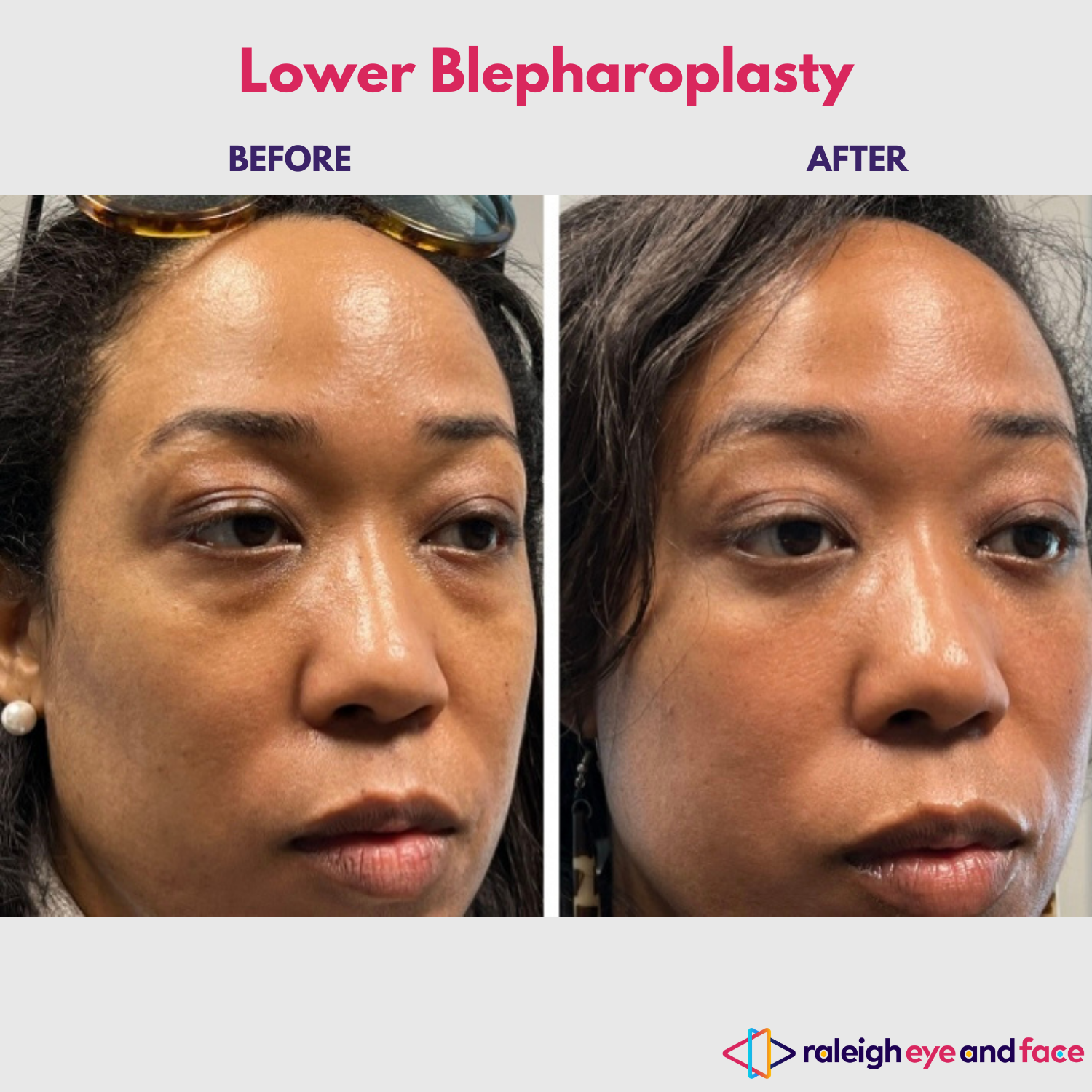 Lower Eyelid Surgery