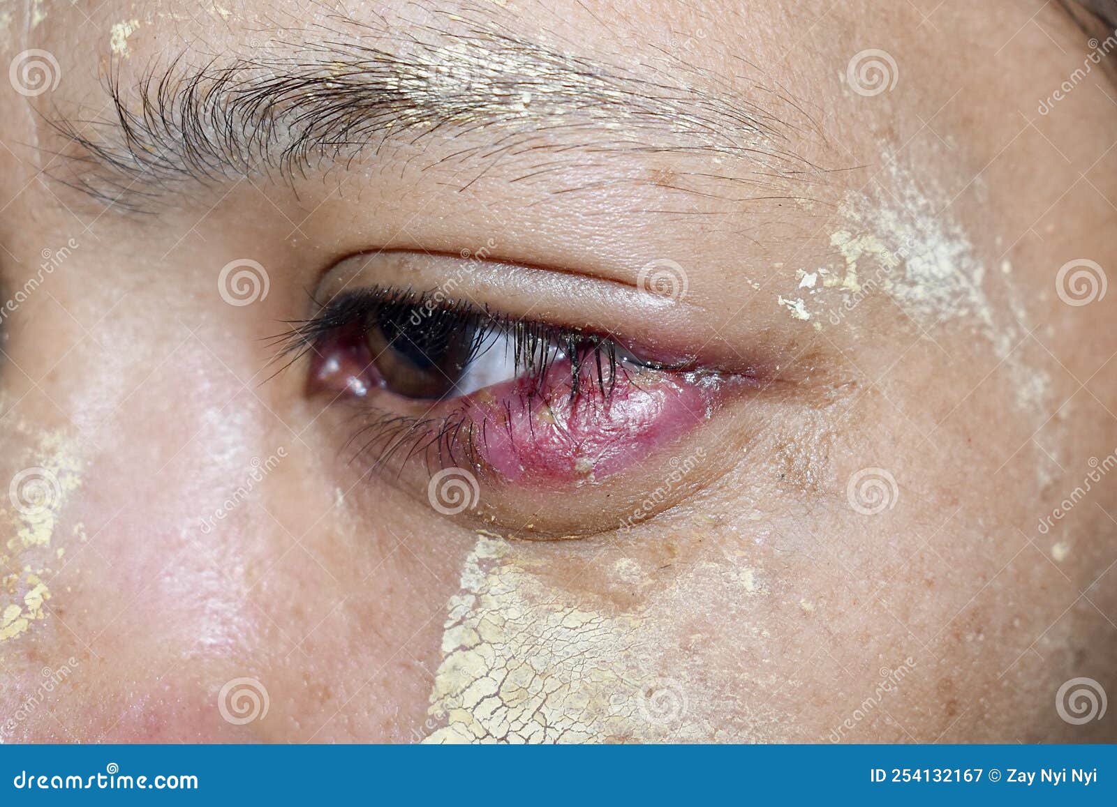 Lower Eyelid Swollen