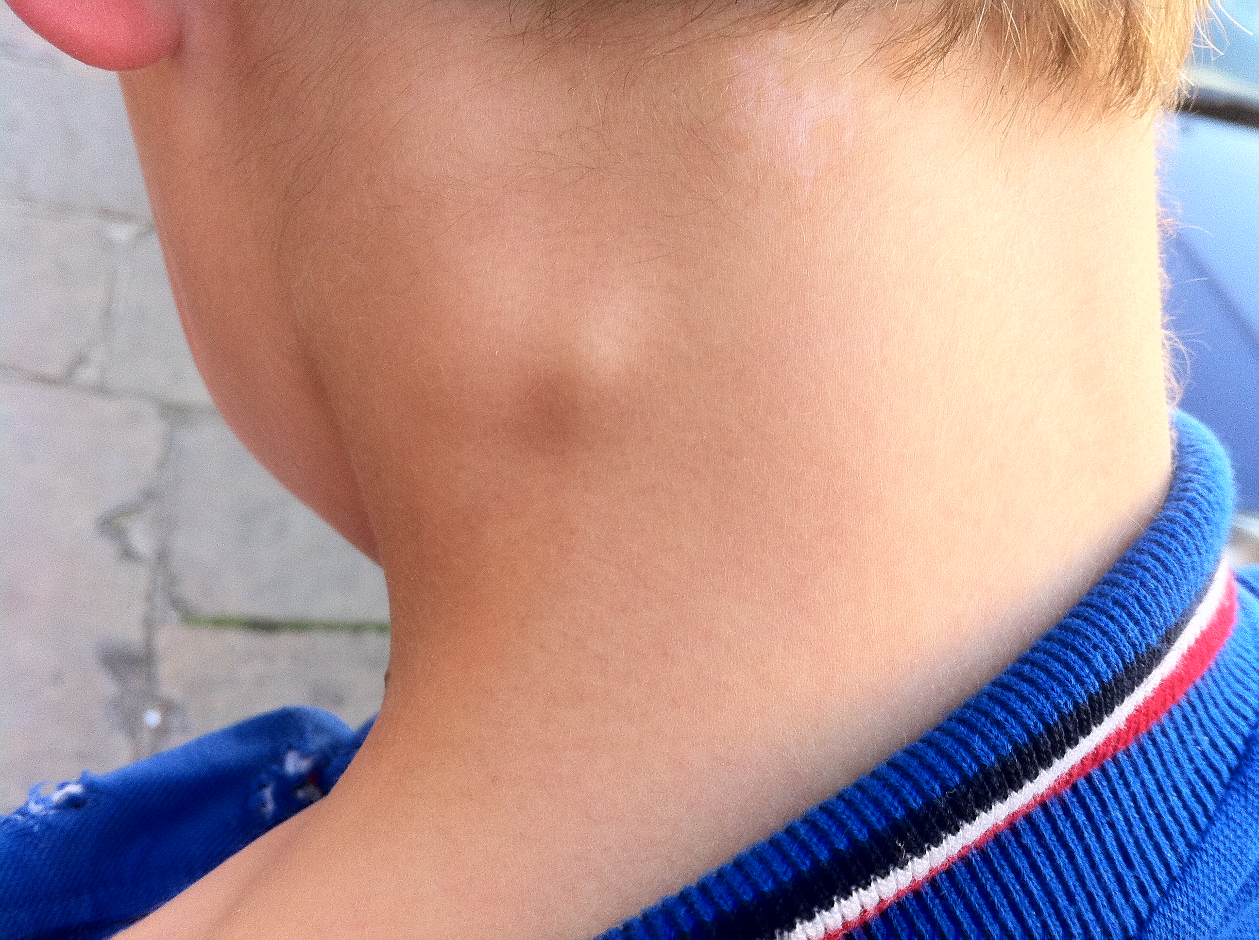 Lump At Neck Side