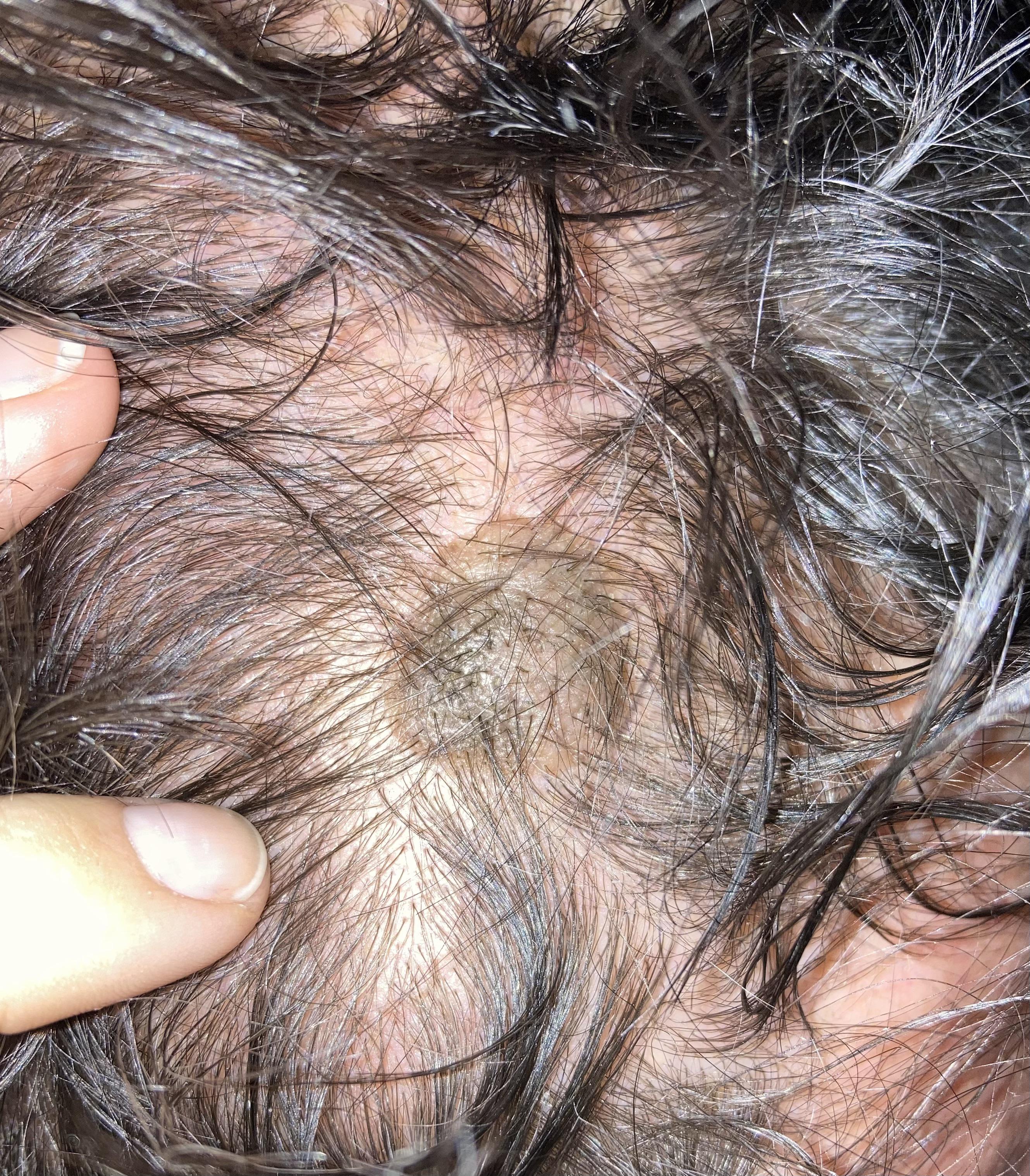 Lump On Scalp