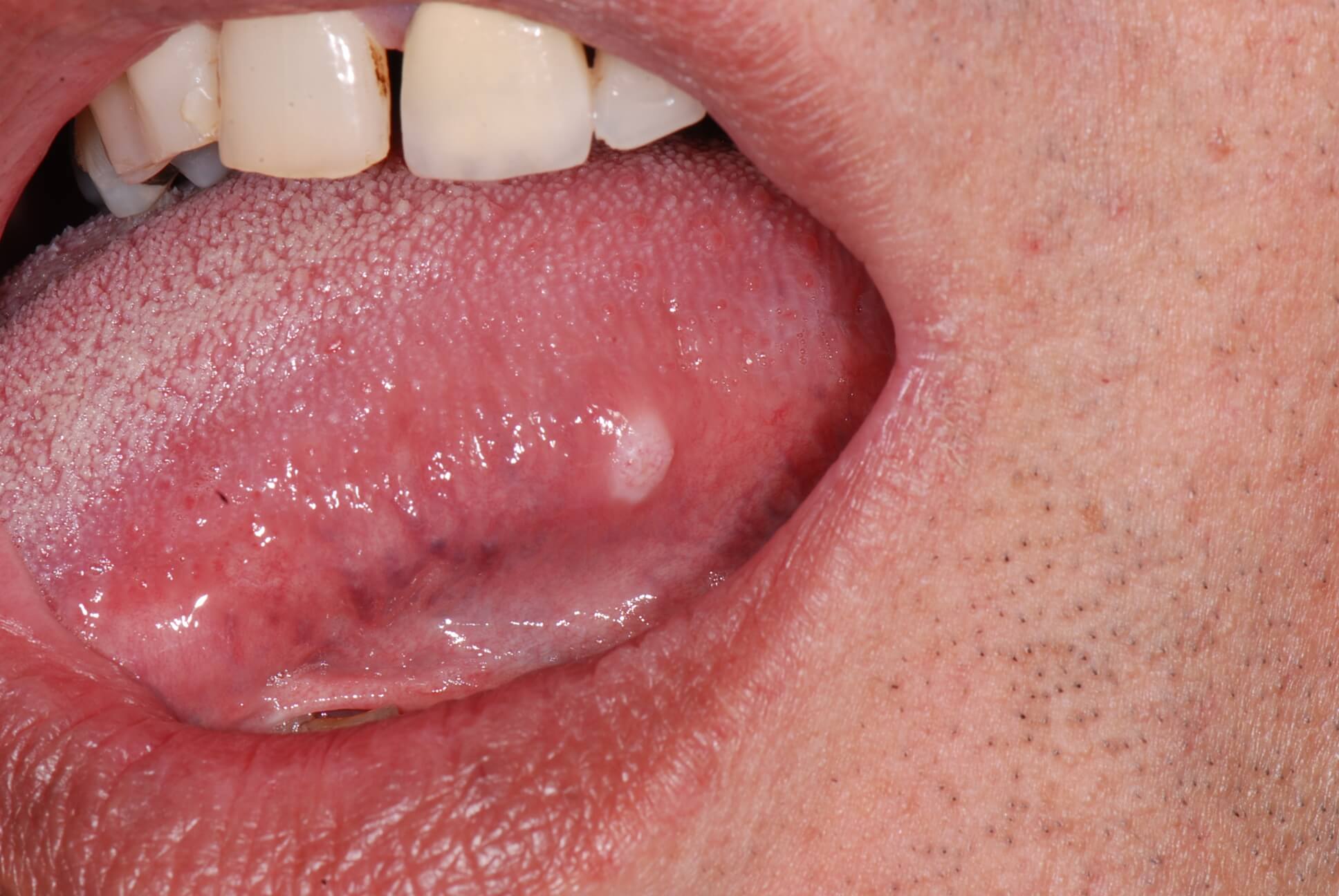 Lump On Tongue Painful