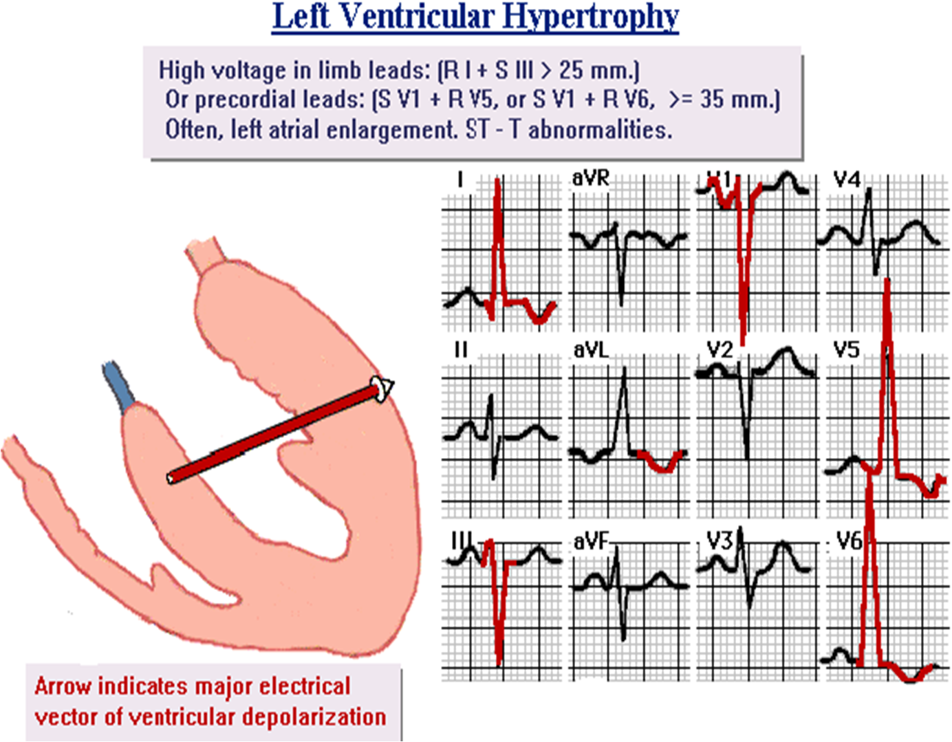 Lvh Ekg