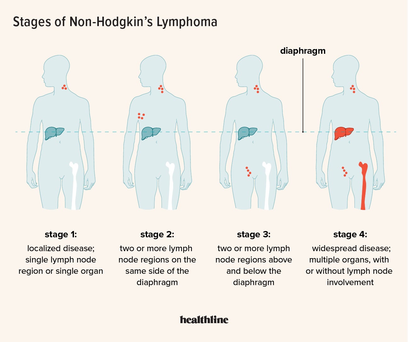 Lymph Cancer Stages