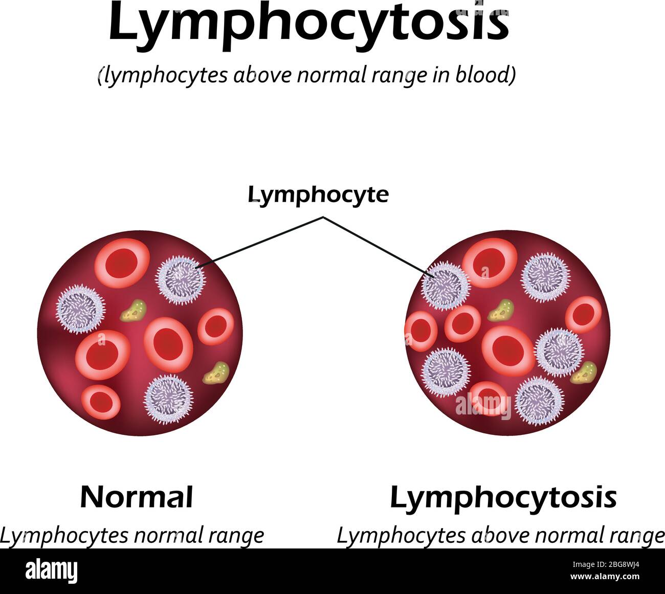 Lymphocytes High Means