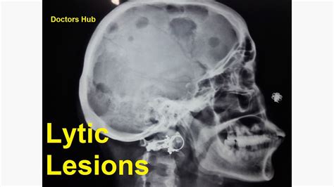 Lytic Bone Lesions