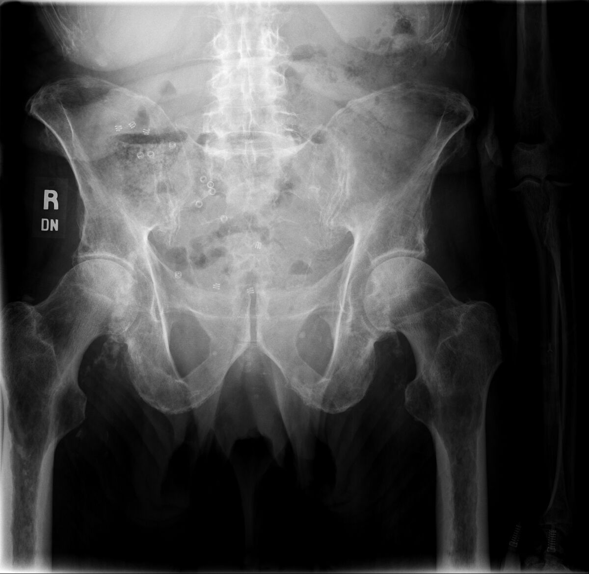 Lytic Skeletal Lesions